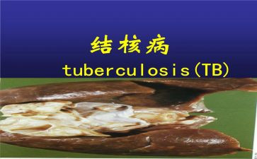 结核工作计划优秀6篇